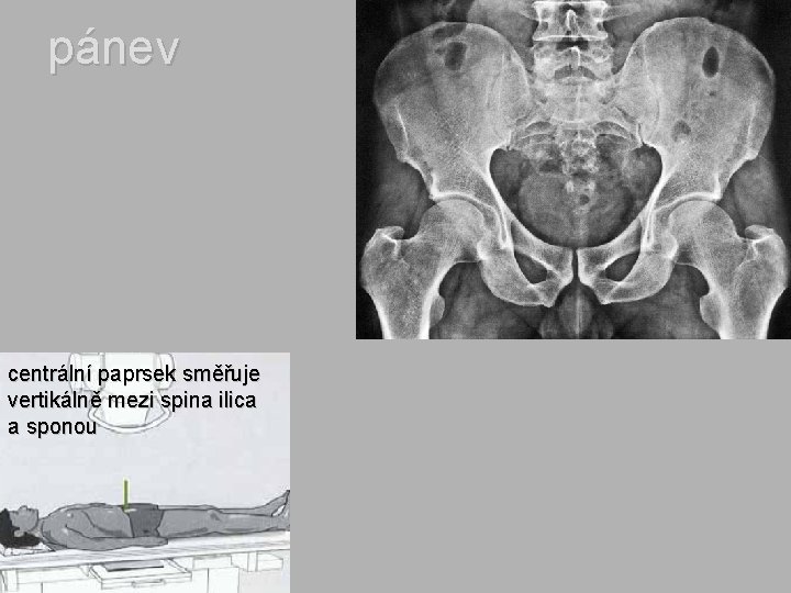 pánev centrální paprsek směřuje vertikálně mezi spina ilica a sponou 