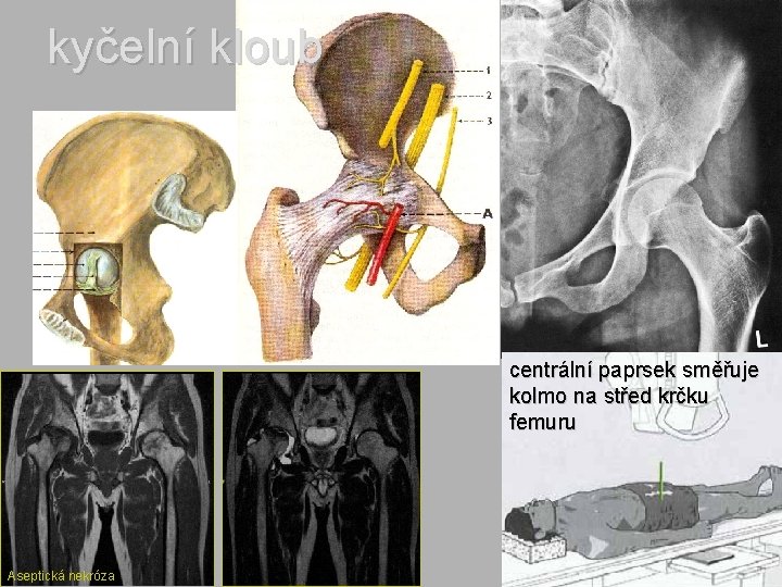 kyčelní kloub centrální paprsek směřuje kolmo na střed krčku femuru Aseptická nekróza 