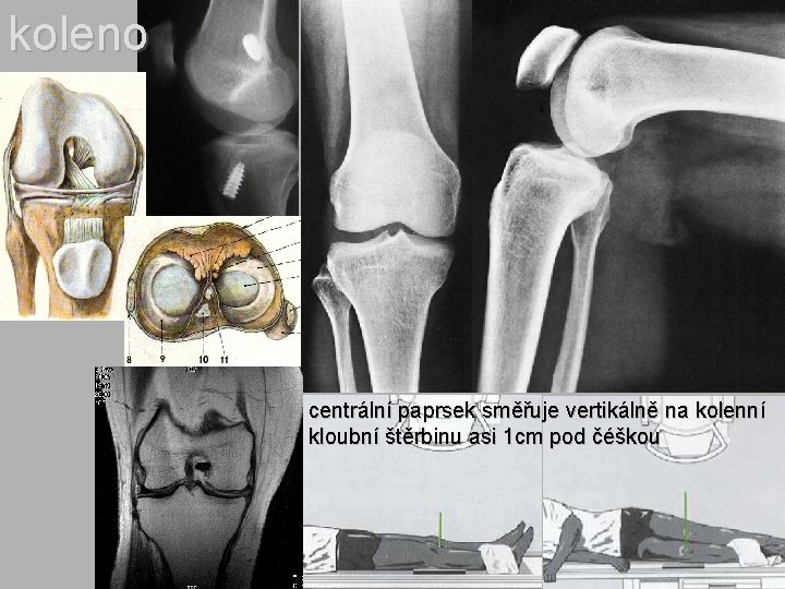 koleno centrální paprsek směřuje vertikálně na kolenní kloubní štěrbinu asi 1 cm pod čéškou