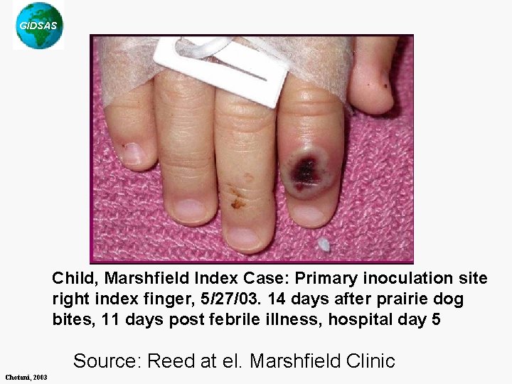 GIDSAS Child, Marshfield Index Case: Primary inoculation site right index finger, 5/27/03. 14 days