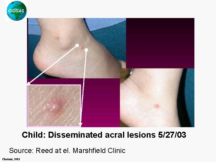 GIDSAS Child: Disseminated acral lesions 5/27/03 Source: Reed at el. Marshfield Clinic Chotani, 2003