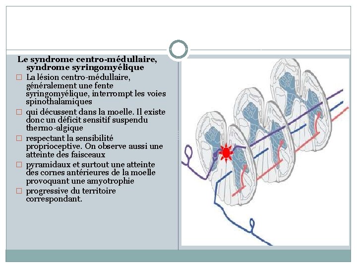 Le syndrome centro-médullaire, syndrome syringomyélique � La lésion centro-médullaire, généralement une fente syringomyélique, interrompt