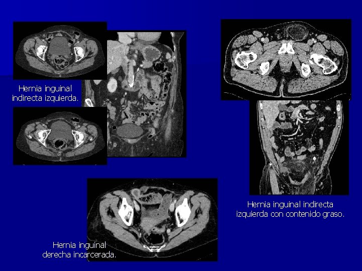 Hernia inguinal indirecta izquierda. Hernia inguinal indirecta izquierda contenido graso. Hernia inguinal derecha incarcerada.