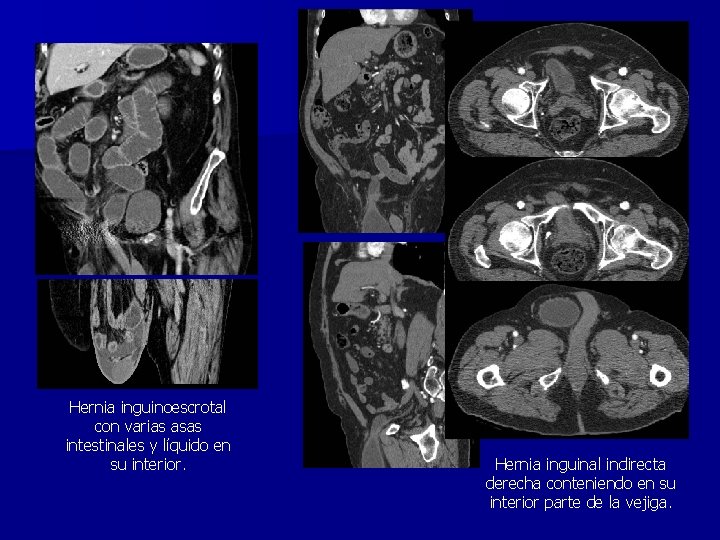 Hernia inguinoescrotal con varias asas intestinales y líquido en su interior. Hernia inguinal indirecta