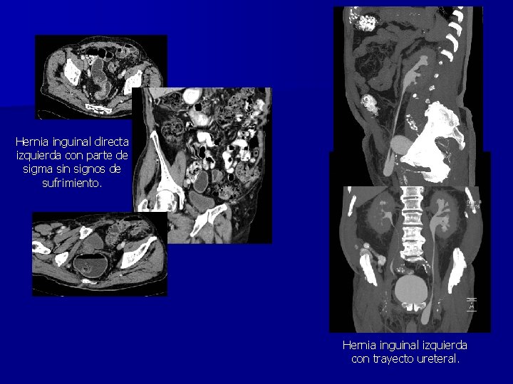 Hernia inguinal directa izquierda con parte de sigma sin signos de sufrimiento. Hernia inguinal