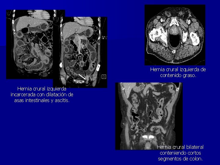 Hernia crural izquierda de contenido graso. Hernia crural izquierda incarcerada con dilatación de asas