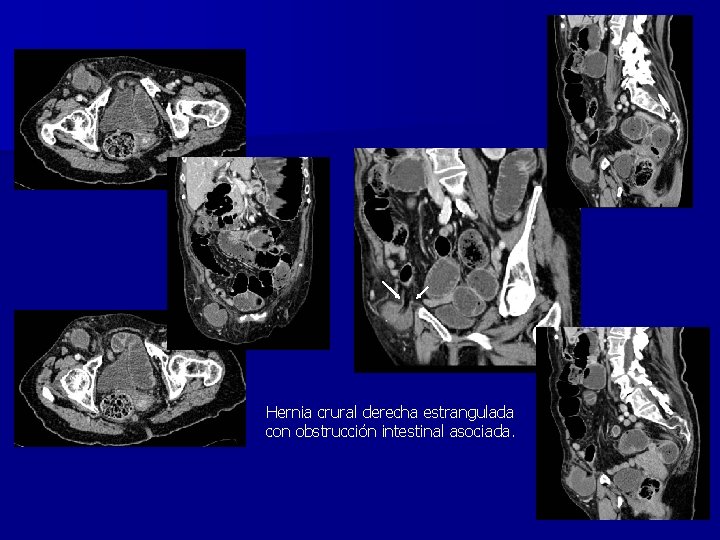 Hernia crural derecha estrangulada con obstrucción intestinal asociada. 