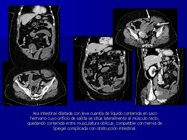 Asa intestinal dilatada con leve cuantía de líquido contenida en saco herniario cuyo orificio