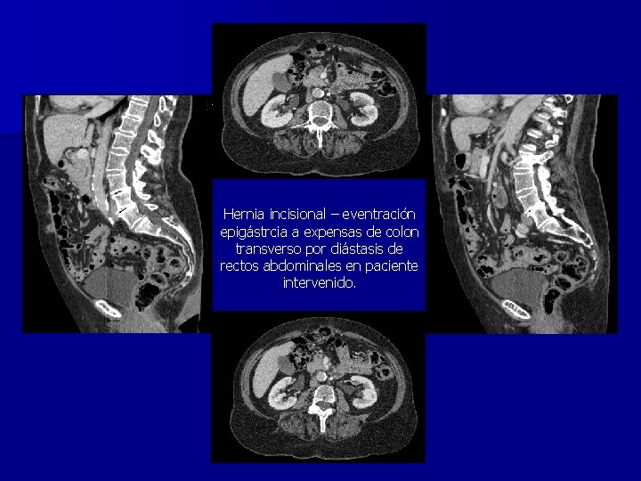 Hernia incisional – eventración epigástrcia a expensas de colon transverso por diástasis de rectos