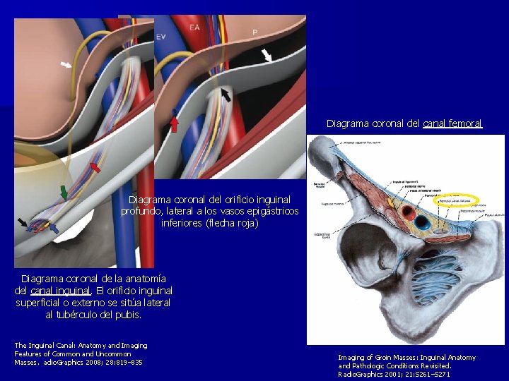 Diagrama coronal del canal femoral Diagrama coronal del orificio inguinal profundo, lateral a los