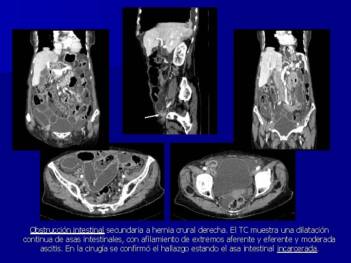 Obstrucción intestinal secundaria a hernia crural derecha. El TC muestra una dilatación continua de