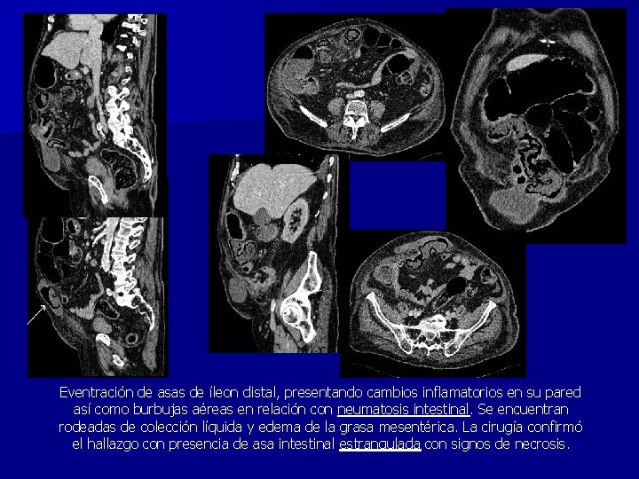 Eventración de asas de íleon distal, presentando cambios inflamatorios en su pared así como