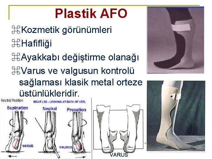 Plastik AFO ⌘Kozmetik görünümleri ⌘Hafifliği ⌘Ayakkabı değiştirme olanağı ⌘Varus ve valgusun kontrolü sağlaması klasik