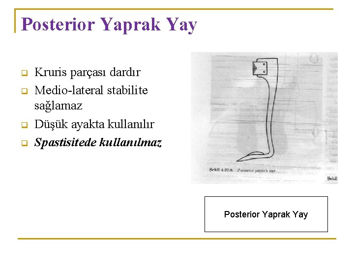 Posterior Yaprak Yay q q Kruris parçası dardır Medio-lateral stabilite sağlamaz Düşük ayakta kullanılır