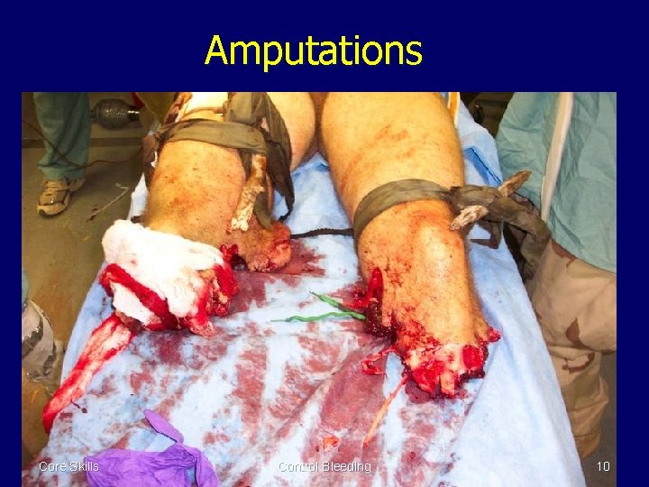 Amputations Core Skills Control Bleeding 10 