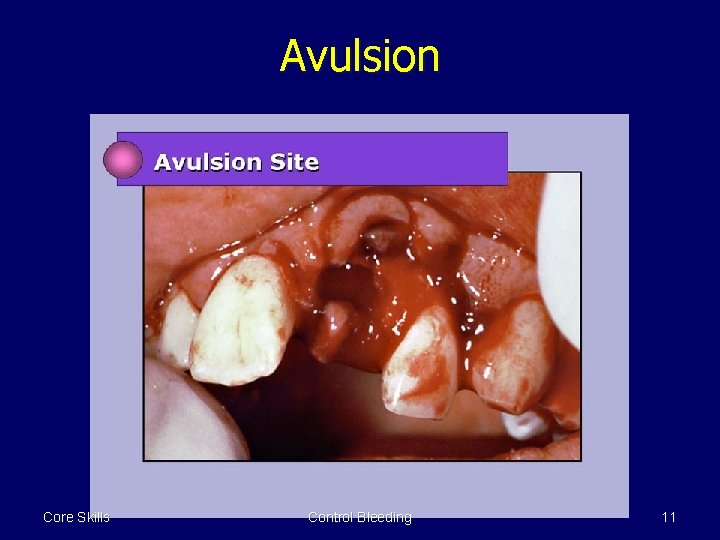 Avulsion Core Skills Control Bleeding 11 