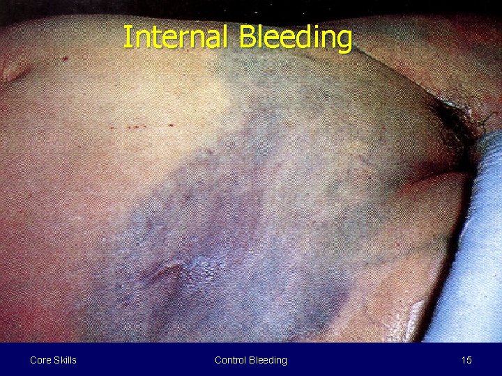 Internal Bleeding Core Skills Control Bleeding 15 