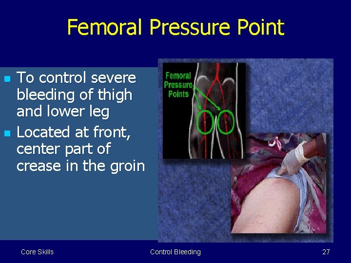 Femoral Pressure Point n n To control severe bleeding of thigh and lower leg