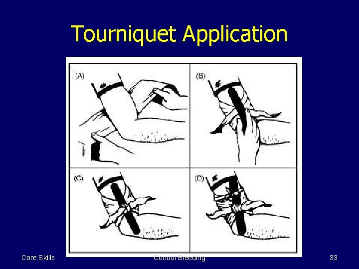 Tourniquet Application Core Skills Control Bleeding 33 