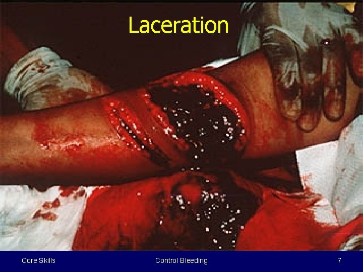 Laceration Core Skills Control Bleeding 7 