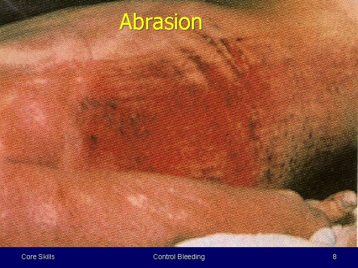 Abrasion Core Skills Control Bleeding 8 