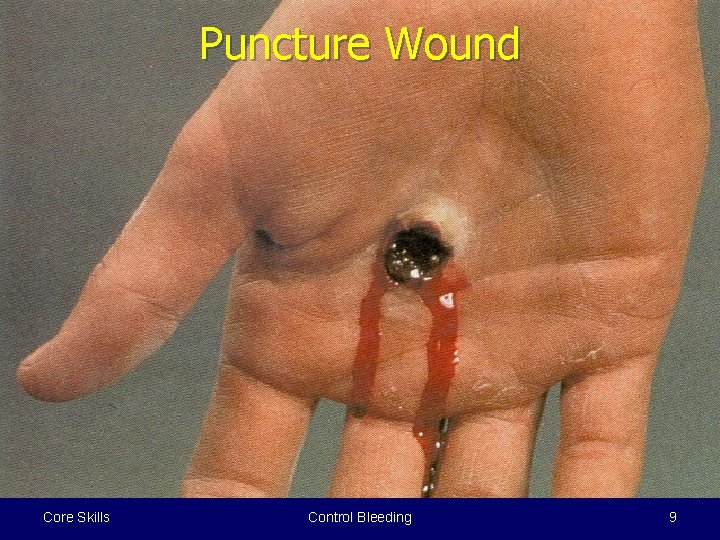 Puncture Wound Core Skills Control Bleeding 9 