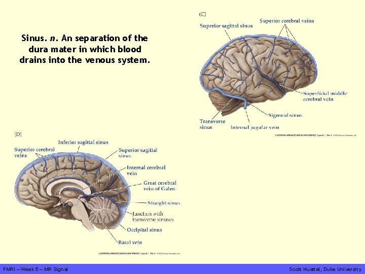 Sinus. n. An separation of the dura mater in which blood drains into the