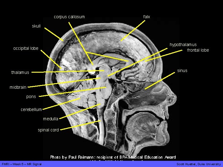 corpus callosum falx skull hypothalamus frontal lobe occipital lobe sinus thalamus midbrain pons cerebellum