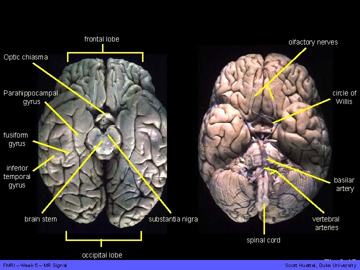 frontal lobe olfactory nerves Optic chiasma Parahippocampal gyrus circle of Willis fusiform gyrus inferior