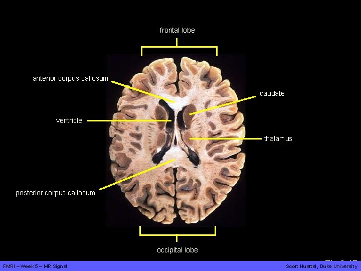 frontal lobe anterior corpus callosum caudate ventricle thalamus posterior corpus callosum occipital lobe FMRI