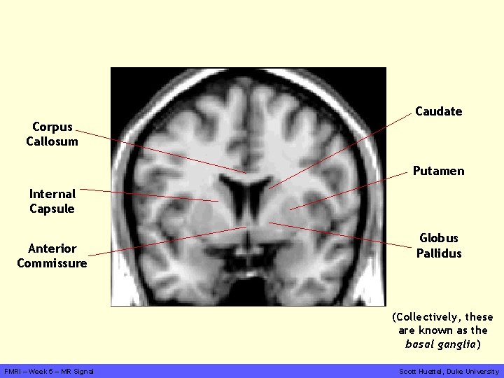 Caudate Corpus Callosum Putamen Internal Capsule Anterior Commissure Globus Pallidus (Collectively, these are known