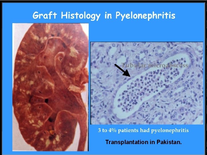 Transplantation in Pakistan. 