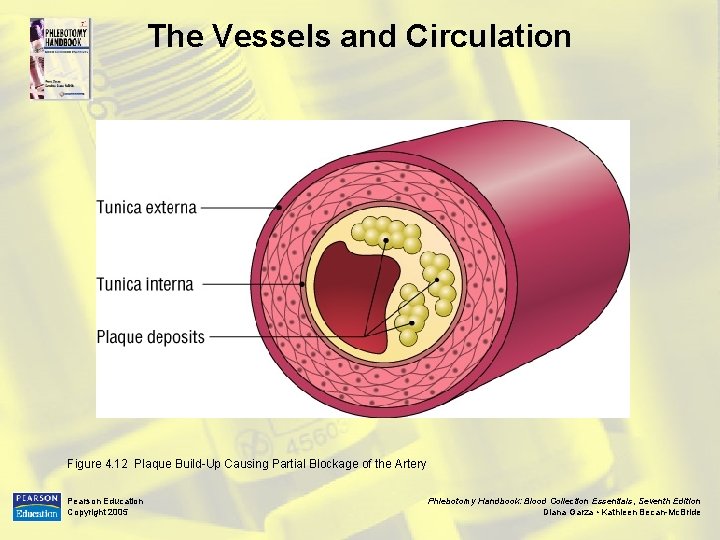 The Vessels and Circulation Figure 4. 12 Plaque Build-Up Causing Partial Blockage of the