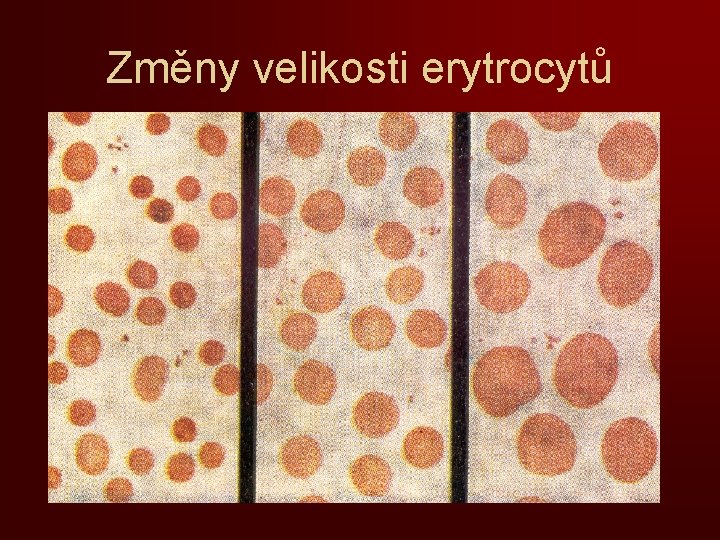 Změny velikosti erytrocytů 