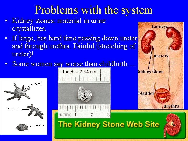 Problems with the system • Kidney stones: material in urine crystallizes. • If large,