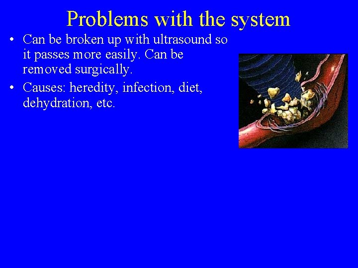 Problems with the system • Can be broken up with ultrasound so it passes