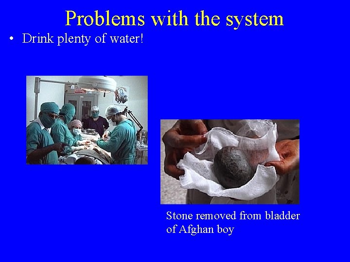 Problems with the system • Drink plenty of water! Stone removed from bladder of