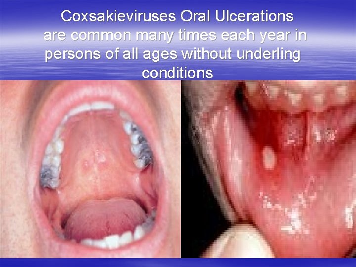 Coxsakieviruses Oral Ulcerations are common many times each year in persons of all ages