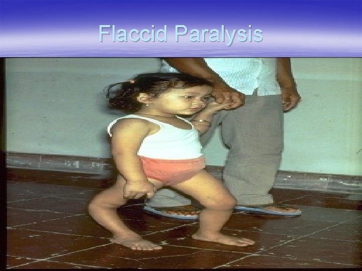 Flaccid Paralysis 