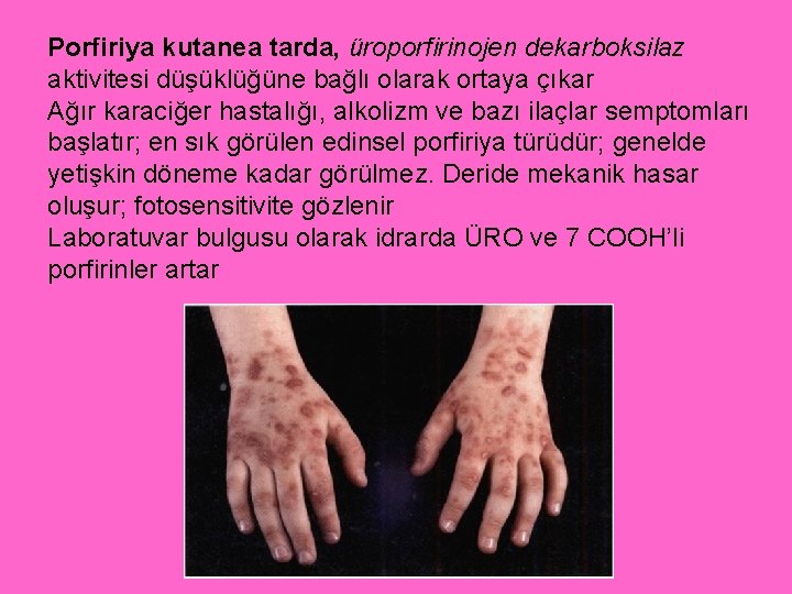 Porfiriya kutanea tarda, üroporfirinojen dekarboksilaz aktivitesi düşüklüğüne bağlı olarak ortaya çıkar Ağır karaciğer hastalığı,