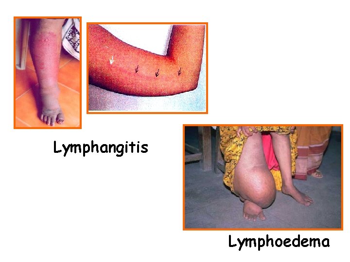 Lymphangitis Lymphoedema 