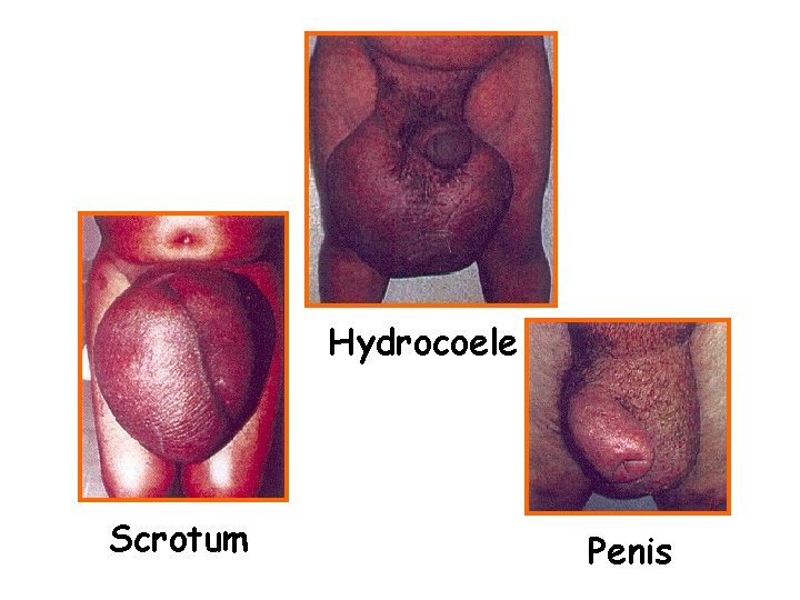 Hydrocoele Scrotum Penis 