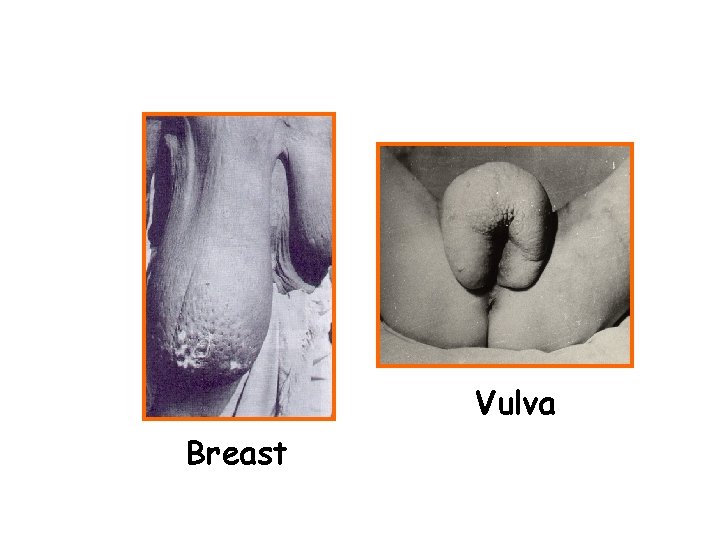 Vulva Breast 