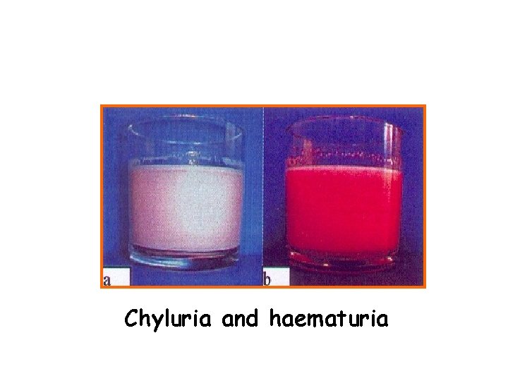 Chyluria and haematuria 