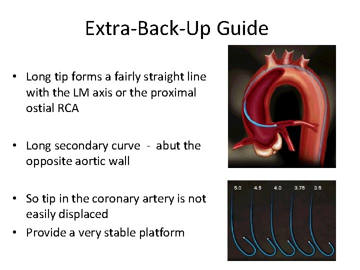 Extra-Back-Up Guide • Long tip forms a fairly straight line with the LM axis