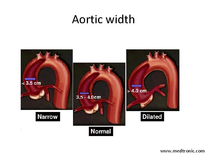 Aortic width www. medtronic. com 