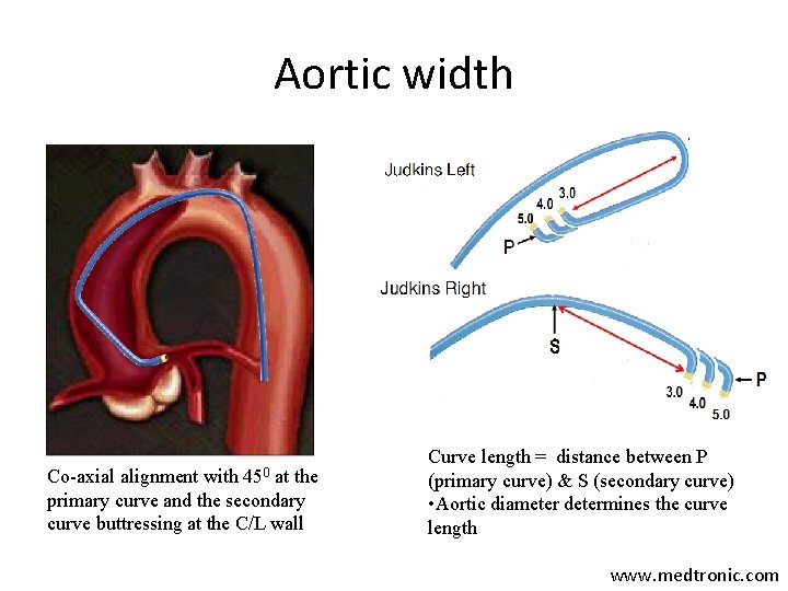 Aortic width 450 Co-axial alignment with at the primary curve and the secondary curve