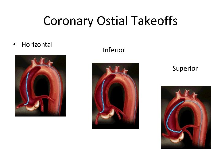 Coronary Ostial Takeoffs • Horizontal Inferior Superior 