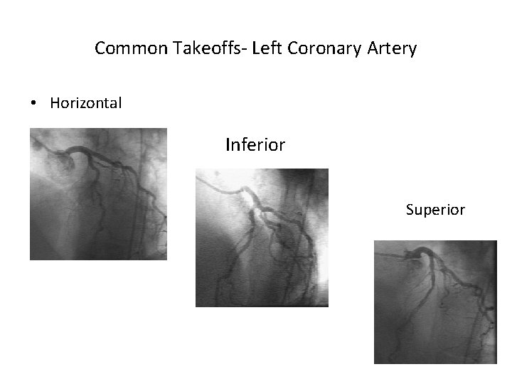 Common Takeoffs- Left Coronary Artery • Horizontal Inferior Superior 