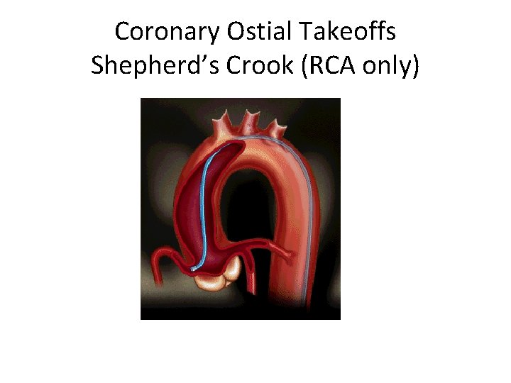 Coronary Ostial Takeoffs Shepherd’s Crook (RCA only) 